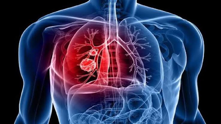 Lung cancer soon knows: there is a way to survive before it spreads.