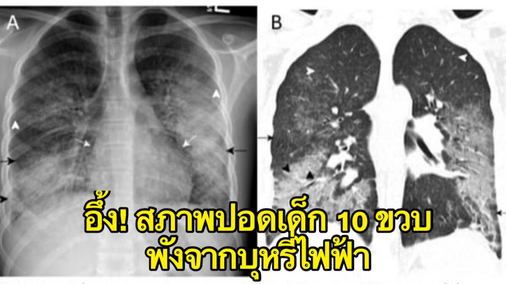 Stunned!  I saw a 10 year old boy with pneumonia.  he has a condition honeycomb from e-cigarettes