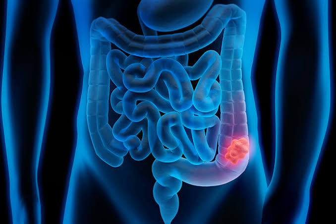 Fifteen Women Die Per Day Due to 2-fold Increase in Colon Cancer Cases.