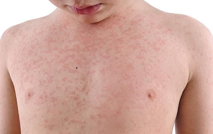 “Measles Outbreak Alert: 5 Provinces with Highest Morbidity Rate Among Children”