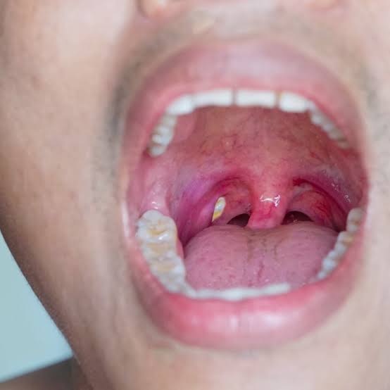 reveal-the-cause-of-tonsil-stones-the-cause-of-bad-breath-itchy