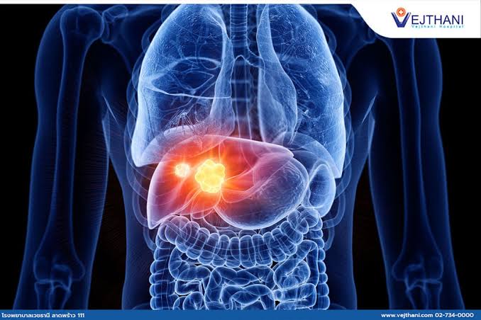 Advancements in Liver Cancer Treatment: The Role of TACE