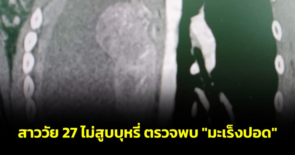 beard!  A 27-year-old non-smoker was diagnosed with “lung cancer” in “Nong Oil,” a patient with lung cancer in the final stage.  Warning: If you experience abnormal symptoms, hurry and see a doctor.